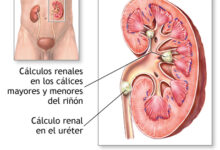 Descubre cómo se forman las piedras en los riñones y cómo prevenirlas descubre-como-se-forman-las-piedras-en-los-rinones-y-como-prevenirlas