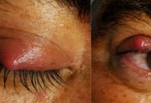 Los misterios detrás del orzuelo: cómo surge y cómo tratarlo los-misterios-detras-del-orzuelo-como-surge-y-como-tratarlo